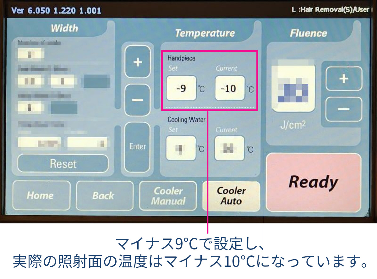 氷点下脱毛のIPLの照射