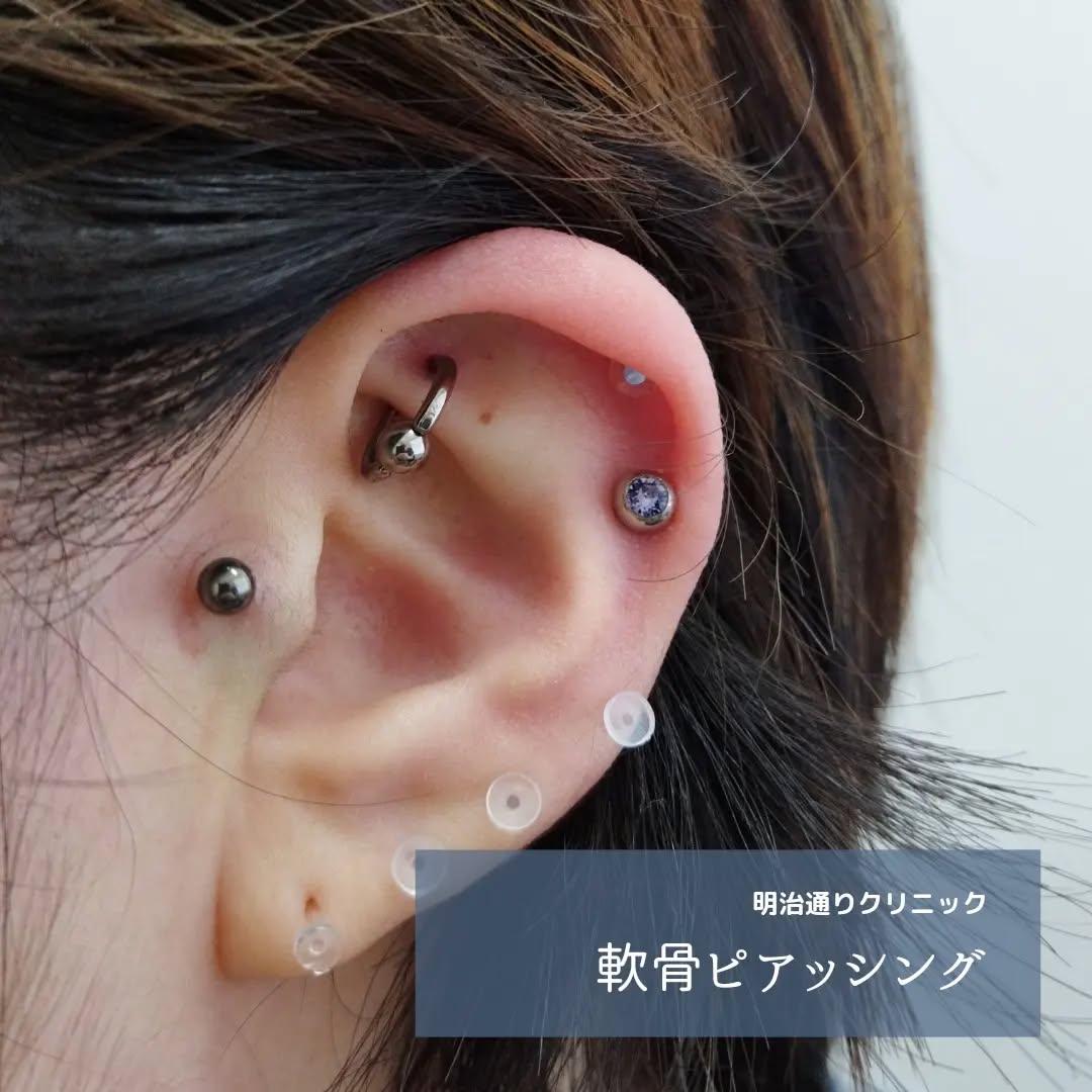 軟骨ピアス症例1