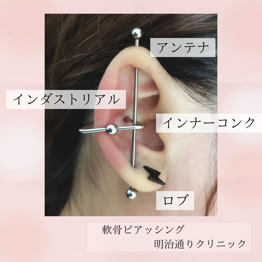 軟骨ピアス症例4 アンテナ・インナーコンク・ロブ