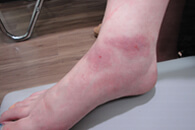 右足首虫刺症および凍傷様皮疹