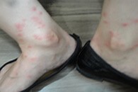 蚊による虫刺症蚊唾液アレルギーの可能性