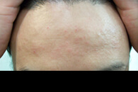 皮脂欠乏性湿疹およびアレルギー性皮膚炎